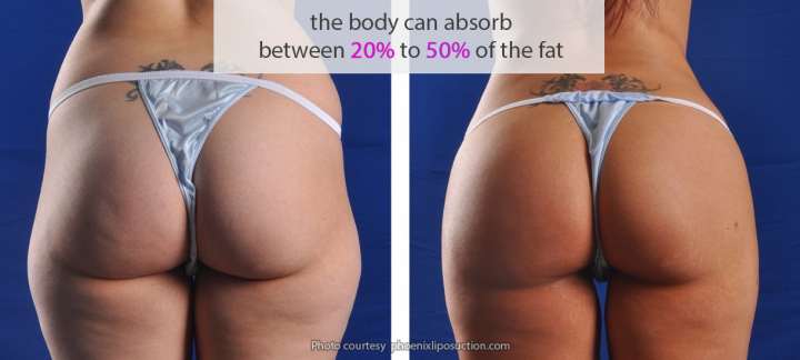 El cuerpo absorbre entre 20% y 50% de la grasa durante la recuperación