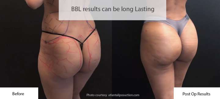 Brazilian Butt Lift Recovery: How To Avoid Sitting After Your BBL