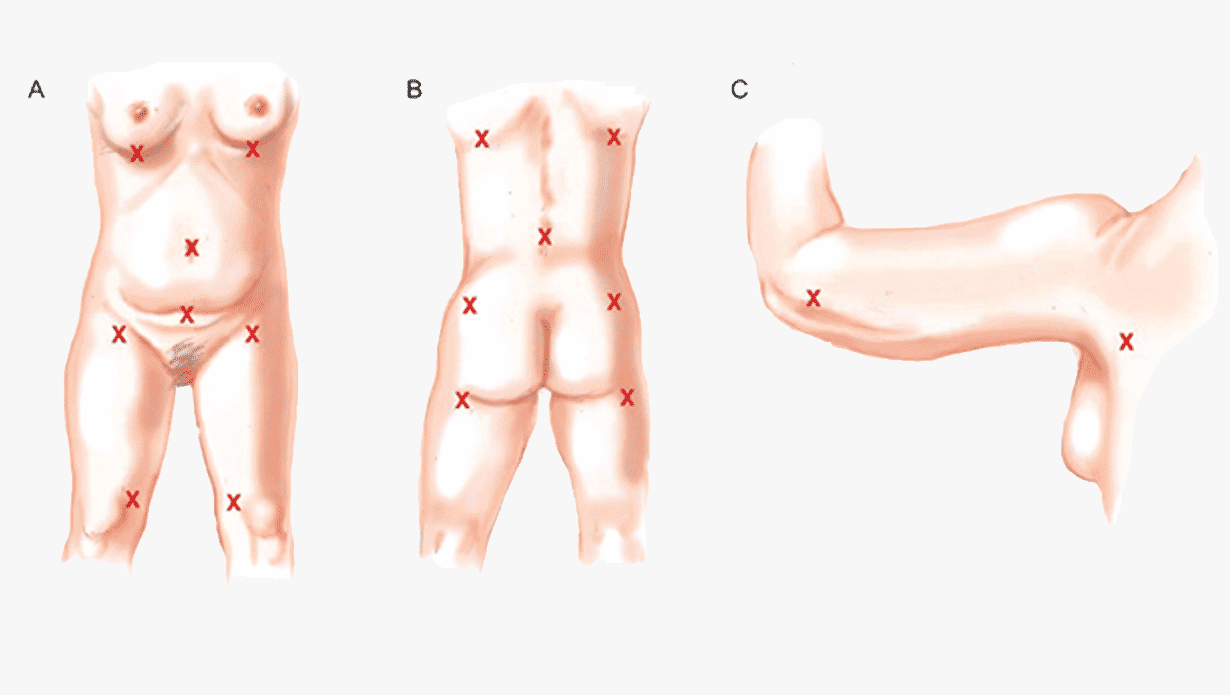 The Brazilian Butt Lift Surgery Explained