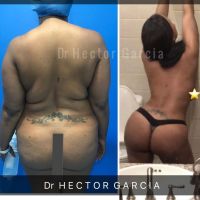 Male Liposuction — Dr. Héctor García