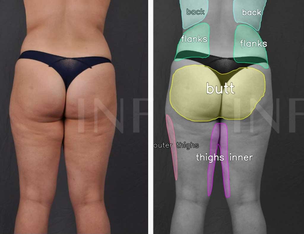Planning your Brazilian Butt Lift - Omaha Liposuction by Imagen