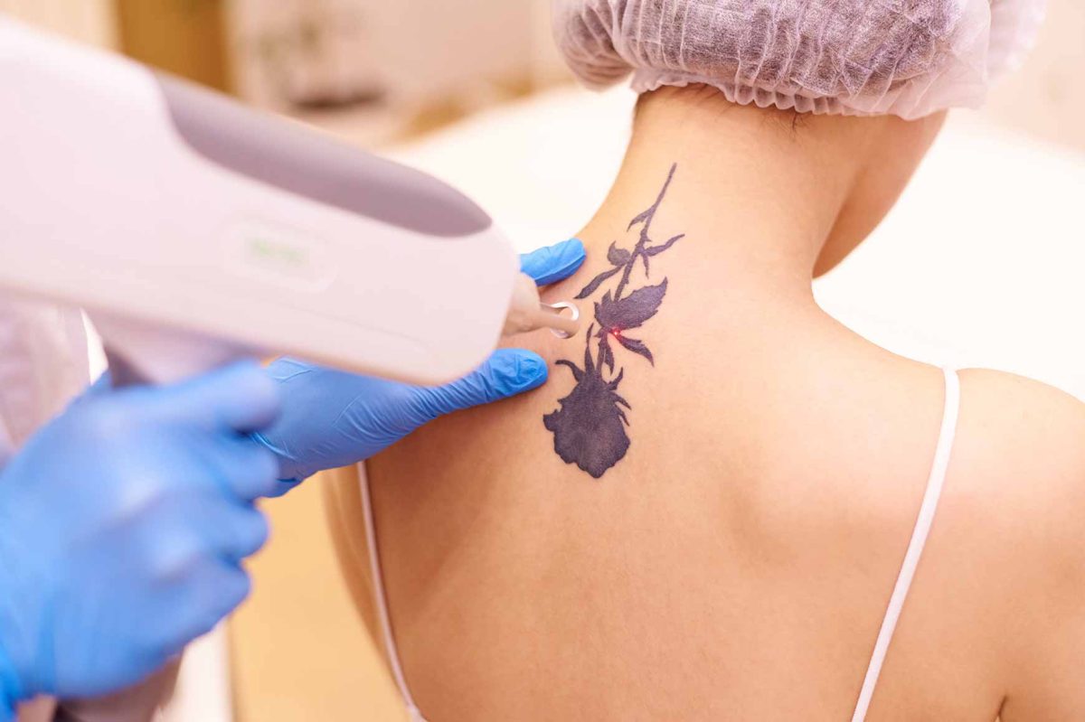 Tattoo Laser Removal Cost: Factors, Payments & Packages