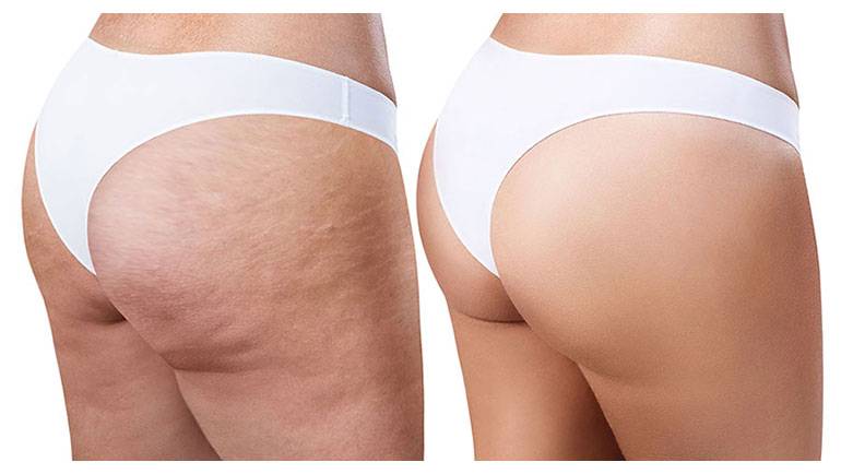 Endermologie for Smoother Results: Banish Cellulite Fast
