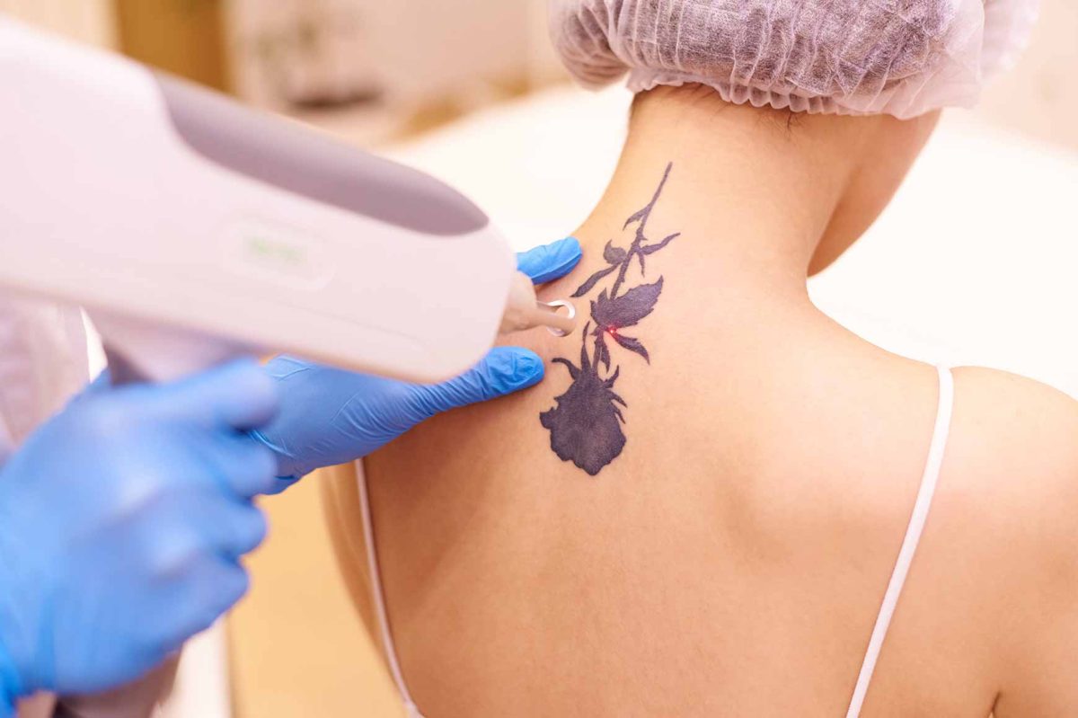 Laser Tattoo Removal: Process, Safety, and Alternatives