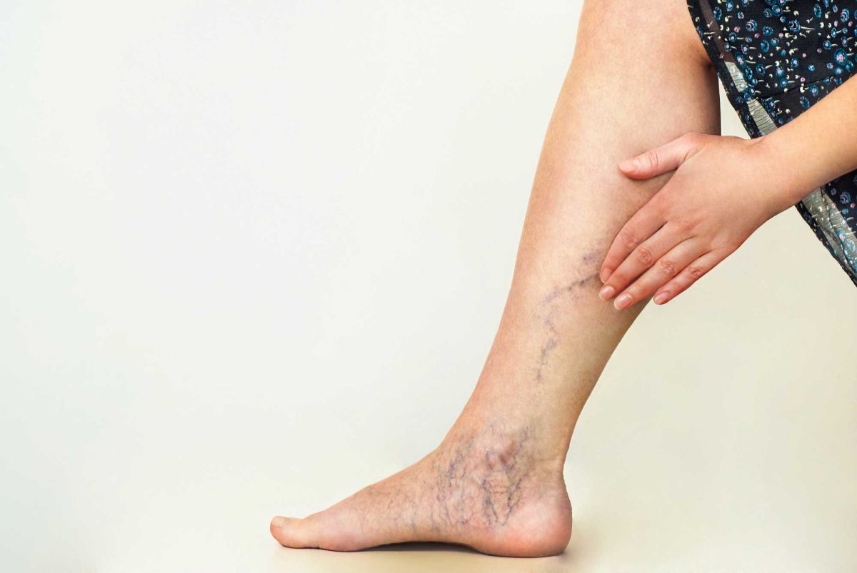 Sclerotherapy Treatment: Benefits, Procedure & Recovery for Varicose Veins