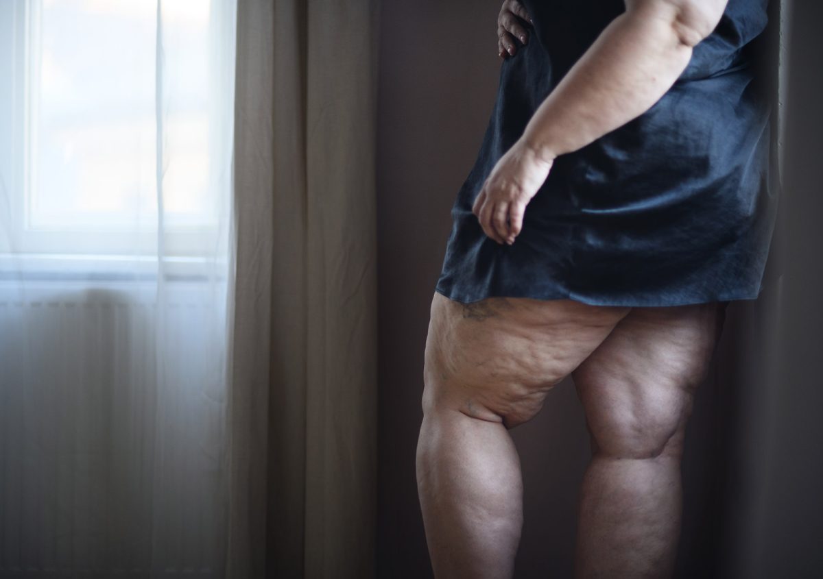 Liposuction for Lipedema: Understanding the Benefits and Risks